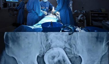 बिहार: मुजफ्फरपुर में पेसेंट के पेट से डॉक्टर ने आपरेशन कर निकाला कांच का गिलास, कहा- निगल गया था चाय पीते