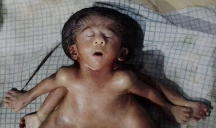 Bihar: छपरा में चार-चार हाथ-पैर वाले विचित्र बच्ची का जन्म, कुछ ही देर में हो गयी नवजात की मौत